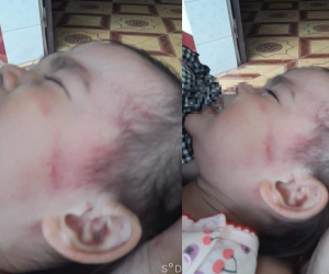 Điều tra vụ bé gái 26 tháng nghi bị bạo hành sau khi đi học 3 ngày
