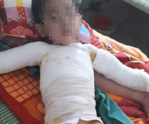 Nghịch bật lửa, bé trai 5 tuổi bị bỏng toàn thân