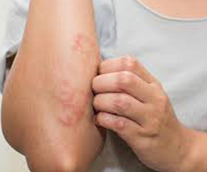 Kỳ lạ cách chữa dị ứng thời tiết đơn giản hiệu quả bằng cỏ dại nhưng rất ít người biết