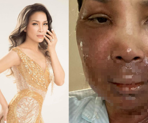 Ca sĩ Hồng Ngọc bất ngờ công khai ảnh bị bỏng 2/3 gương mặt