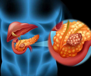 Ung thư tụy, căn bệnh nguy hiểm, rất dễ bị bỏ qua dấu hiệu sớm