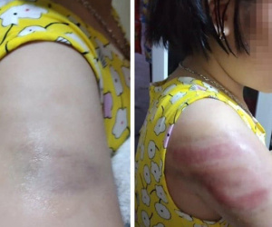 Nam Định: Yêu cầu cô giáo kiểm điểm sau sự việc bé gái bị đánh bầm tím cánh tay vì viết bài chậm