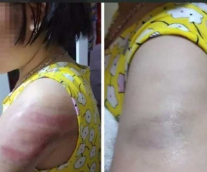 Nữ giáo viên Nam Định đánh học sinh lớp 4 tím tay do mất bình tĩnh, mong được sửa sai