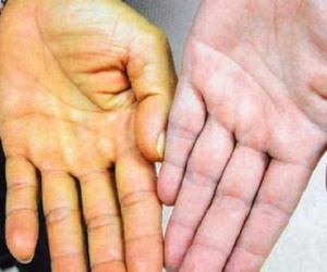 Gan là nhà máy giải độc và bài tiết chất có hại: Có 7 dấu hiệu sau là gan đang kêu cứu