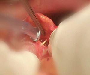 Ngậm tăm sau ăn, người đàn ông Hà Nội phải cắt nửa đại tràng