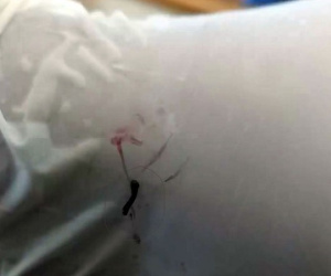 Tá hỏa phát hiện con vắt dài 2cm trong mắt bé trai ở Nghệ An