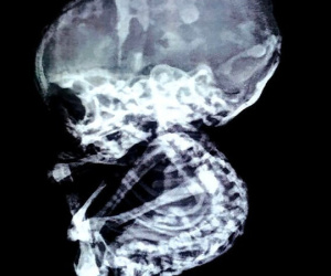 15 năm sau khi phá thai, bà mẹ choáng váng khi phát hiện con vẫn còn trong bụng và hiện tượng bào thai 'hóa đá' hiếm gặp