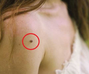 Da đang láng mịn bỗng 'mọc ra' 3 thay đổi bất thường này, hãy đi khám ngay bởi đó là dấu hiệu tế bào ung thư đang xâm lấn cơ thể