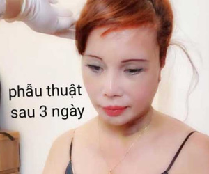 Diện mạo mới của cô dâu 62 tuổi ở Cao Bằng sau 3 ngày khiến dân mạng khiếp vía vì hậu phẫu căng da mặt