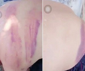 Xác minh vụ người đàn ông bầm tím khắp lưng nghi bị 'vợ hờ' đánh ở Nghệ An