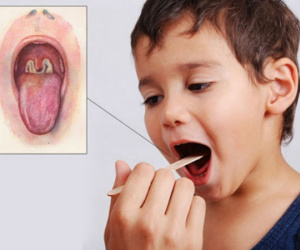Bệnh bạch hầu 'tái xuất' nguy hiểm: Bác sĩ lưu ý những điều quan trọng