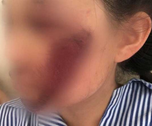 Áo chống nắng cuốn vào bánh xe khiến nữ sinh tổn thương mặt nghiêm trọng