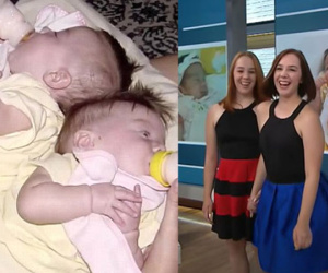 2 con gái sinh đôi dính liền, cha mẹ mất 7 tháng mới quyết định tách rời con, 17 năm sau ai cũng mãn nguyện khi thấy nụ cười của các em