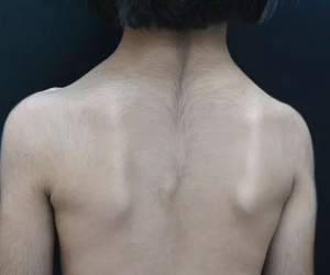 Ca 'bệnh lạ' thứ 75 thế giới vừa ghi nhận tại Việt Nam