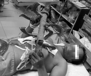 Bác sĩ hốt hoảng khi nam bệnh nhân nhập viện với lưỡi cày cắm trên ngực