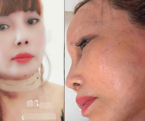 Cô dâu 63 tuổi ở Cao Bằng khoe vết sẹo chạy dọc phần tai sau 1 tháng phẫu thuật căng da mặt khiến nhiều người 'bủn rủn'