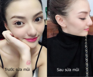 Hồng Quế công khai ảnh sửa mũi lần 2, nhan sắc hơn 10 năm qua đã thay đổi 180 độ nhưng gây tranh cãi lớn