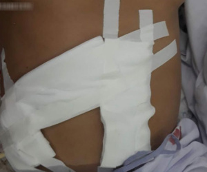 Bị tăng huyết áp và có ngực to như phụ nữ, người đàn ông suýt chết vì khối u lớn 'khủng' ở thận