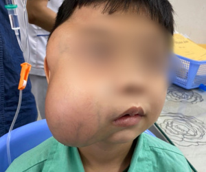 Bé trai 13 tuổi mang khối u xơ vòm họng 'khổng lồ' lần đầu tiên ghi nhận tại Việt Nam