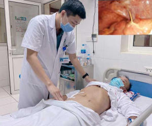 Nuốt phải tăm, người đàn ông bị đâm thủng ruột