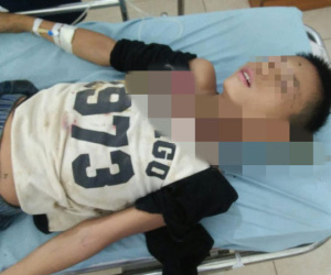 Trèo cây ngã, bé trai 12 tuổi bị cành cây đâm xuyên cổ