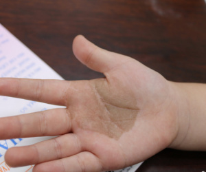 Nhiều cha mẹ tại TP.HCM đưa con đi cầu cứu bác sĩ vì bàn tay, bàn chân xuất hiện các tổn thương lạ