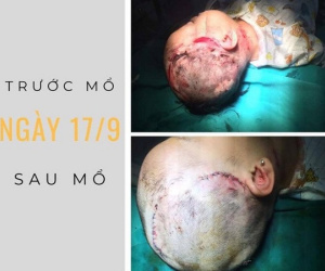 Bé gái 24 tháng tuổi bị chó cắn rách vùng mặt