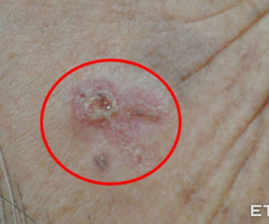 Chủ quan với vết ban đỏ trên trán, người phụ nữ không ngờ đó là dấu hiệu bệnh ung thư
