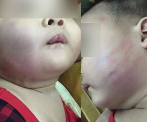 Xôn xao vụ việc bé trai 8 tháng tuổi đi nhà trẻ về bầm tím một bên má, mẹ vừa trông thấy mặt con liền ngất xỉu ngay tại chỗ