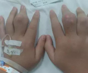 2 ngày 1 cốc trà sữa, hai bàn tay của chàng trai 18 tuổi nổi nhiều cục u to như hạt đào