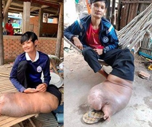 Bị muỗi đốt, chàng trai Campuchia phải sống với cái chân dị dạng suốt hơn 2 thập kỷ