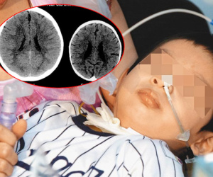 Cậu bé 3 tuổi bị teo não như cụ ông 80, vừa lật áo khám bác sĩ đã giật mình và sự thật kinh hoàng được phơi bày