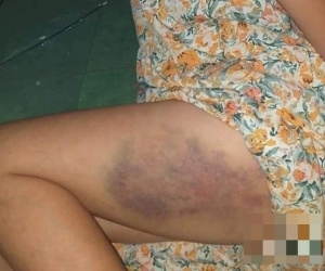 Không mang theo dụng cụ học tập và không làm được bài, bé gái lớp 3 bị cô giáo lấy thước đánh tím bầm một bên đùi để 'cho tiến bộ'