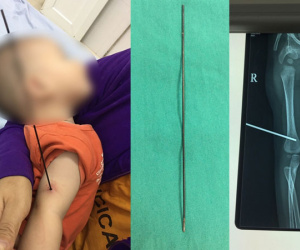 Bé trai 6 tháng tuổi bị nan ô đâm xuyên cánh tay
