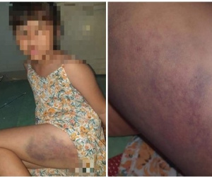 Xử phạt hành chính cô giáo đánh bầm tím đùi bé gái lớp 3