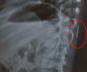 Bé gái 3 tuổi bị sốt cao liên tục, được đưa đi khám thì phát hiện chiếc kim khâu dài 17mm trong cột sống