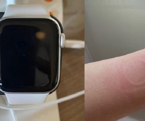 Apple Watch SE gặp lỗi quá nhiệt, khiến người dùng bị bỏng và làm hỏng màn hình