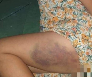 Phạt tiền, đình chỉ dạy 3 tháng cô giáo đánh bé lớp 3 bầm dập