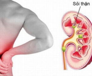 Chuyên gia chỉ rõ 5 thói quen ăn uống là nguyên nhân gây sỏi thận, cần loại bỏ sớm
