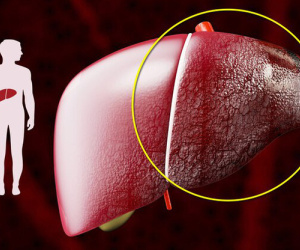 Đừng đùa với xơ gan: Ngoài rượu, còn 5 "thủ phạm" gây tổn thương gan không hồi phục