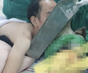 Tai nạn kinh hoàng: Chàng trai 27 tuổi bị máy xay thịt cuốn cả cánh tay đến sát vai, mặt bị kéo vào mâm inox, tình trạng nguy kịch