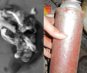 Nổ bình gas mini, người đàn ông mất cả bàn tay phải