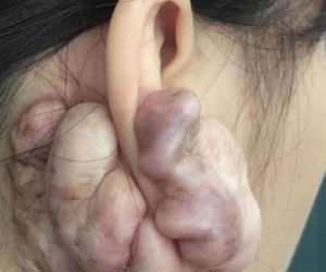 Hình ảnh sẹo đùn kín tai 'do nâng mũi bằng sụn tai' gây sốc trên MXH: Có hay không việc sửa mũi đẹp xong khiến tai bị dị dạng?