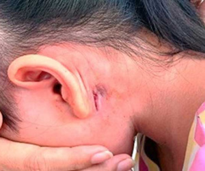 Quảng Trị ghi nhận 4 trường hợp tử vong có liên quan đến bệnh Whitmore