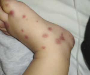 Tưởng vết ban đơn thuần, ai ngờ mắc bệnh cực hiếm Việt Nam chưa ghi nhận