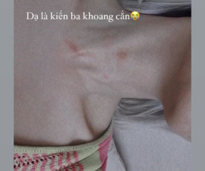 Cổ Châu Bùi xuất hiện vết lạ, sợ dân mạng nghĩ là hickey giống Ngọc Trinh hay sao mà vội thanh minh thế này