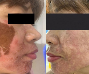Trị nám da không đúng cách, nhiều chị em phải trả giá bằng... cả khuôn mặt