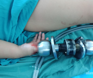 Bé trai 3 tuổi bị ổ khóa nhà 'ngoạm' tay khóc thét, phải nhập viện cấp cứu