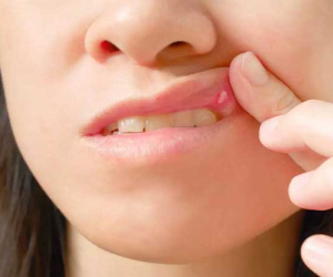 Vết loét miệng hay bị bỏ qua có thể là dấu hiệu của ung thư