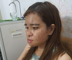 Người phụ nữ bị đánh hội đồng gãy quai hàm ngay tại nhà ở Bình Dương